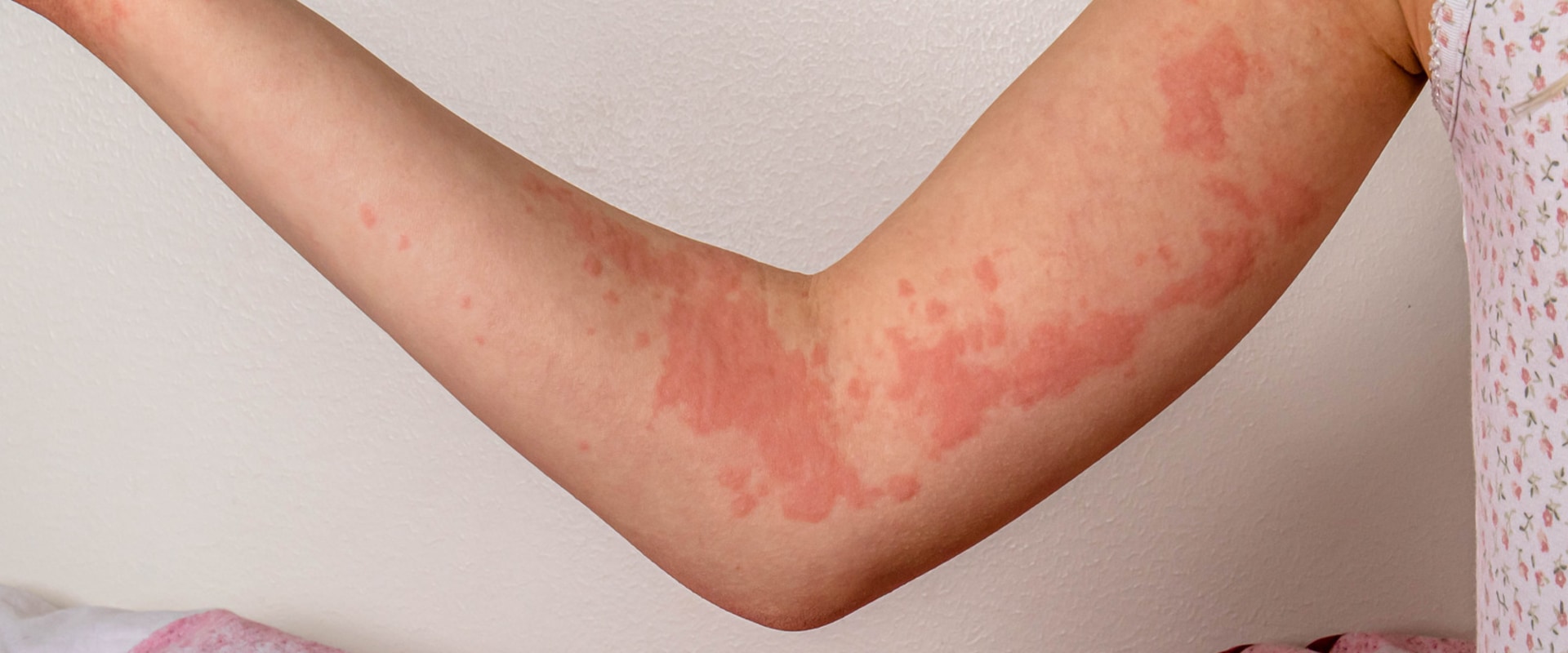Common Triggers of Allergic Reactions During IV Therapy