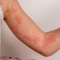 Common Triggers of Allergic Reactions During IV Therapy