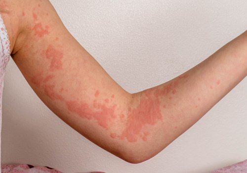 Common Triggers of Allergic Reactions During IV Therapy